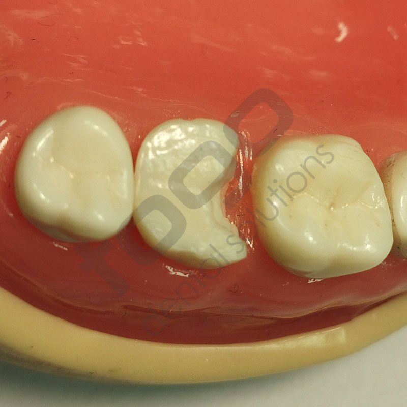 Rhondium Derin Marjin Kaması _ Küçük _ Premolar_ 50 Adet