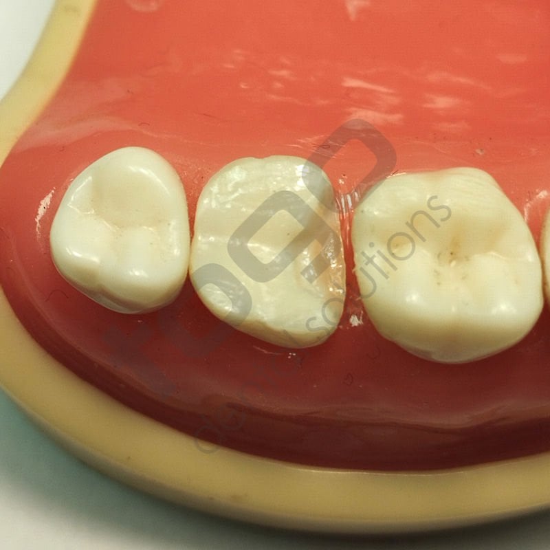 Rhondium Derin Marjin Kaması _ Küçük _ Premolar_ 50 Adet