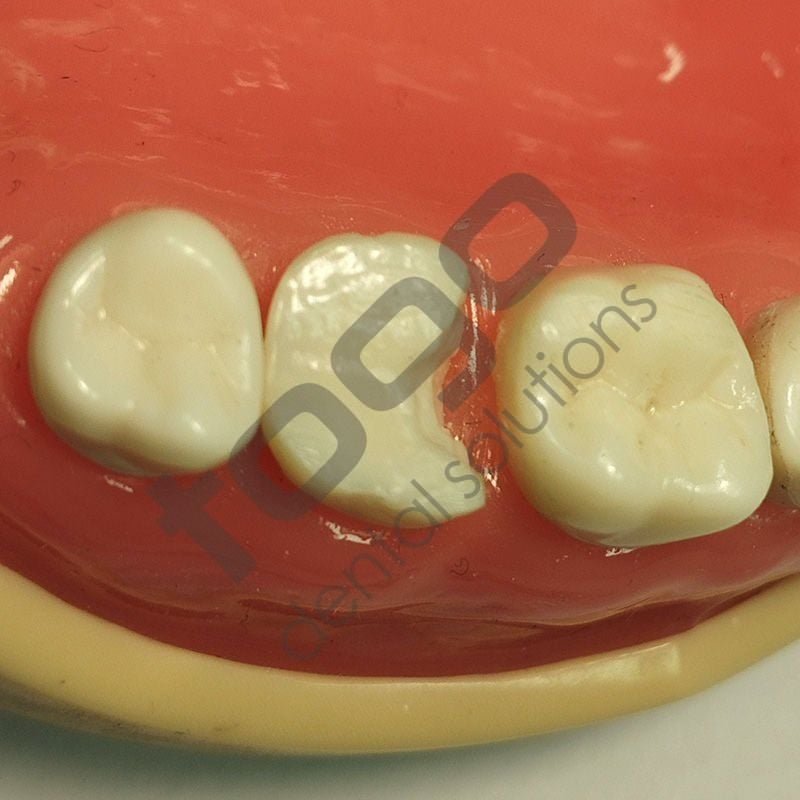 Rhondium Derin Marjin Kaması _ Set _ 100 Adet