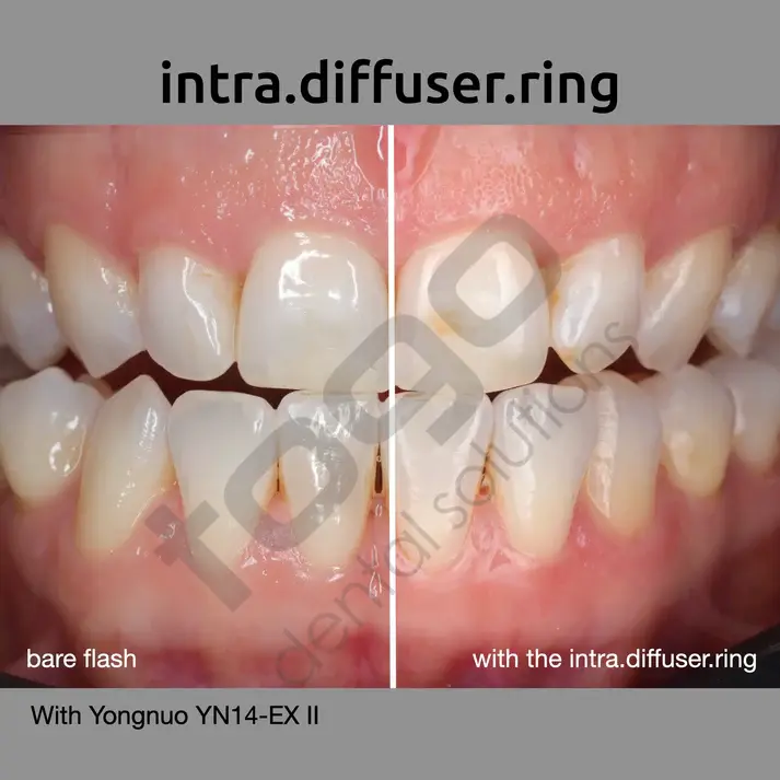 Intra Diffuser Kit _ Ring Flash