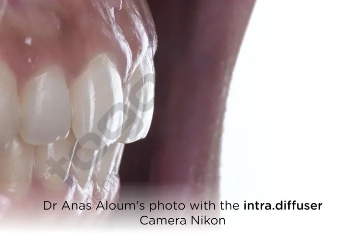 Intra Diffuser Kit _ Twin Flash