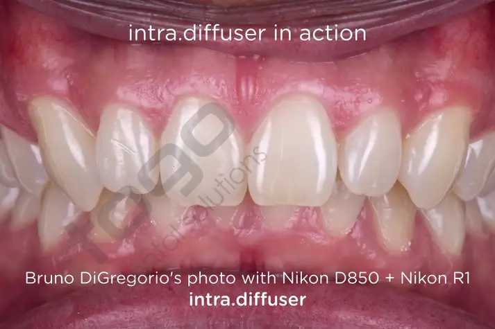 Intra Diffuser Kit _ Twin Flash