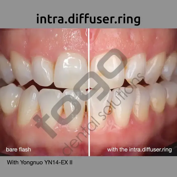 Intra Diffuser & Polar Kit _ Ring Flash