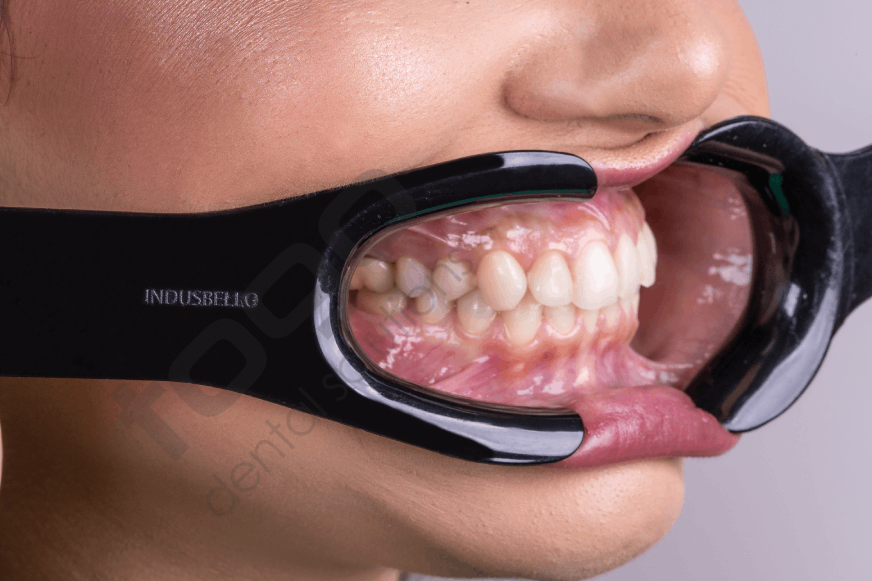 Indusbello Dental Fotoğrafçılık Ekartör Model:V2