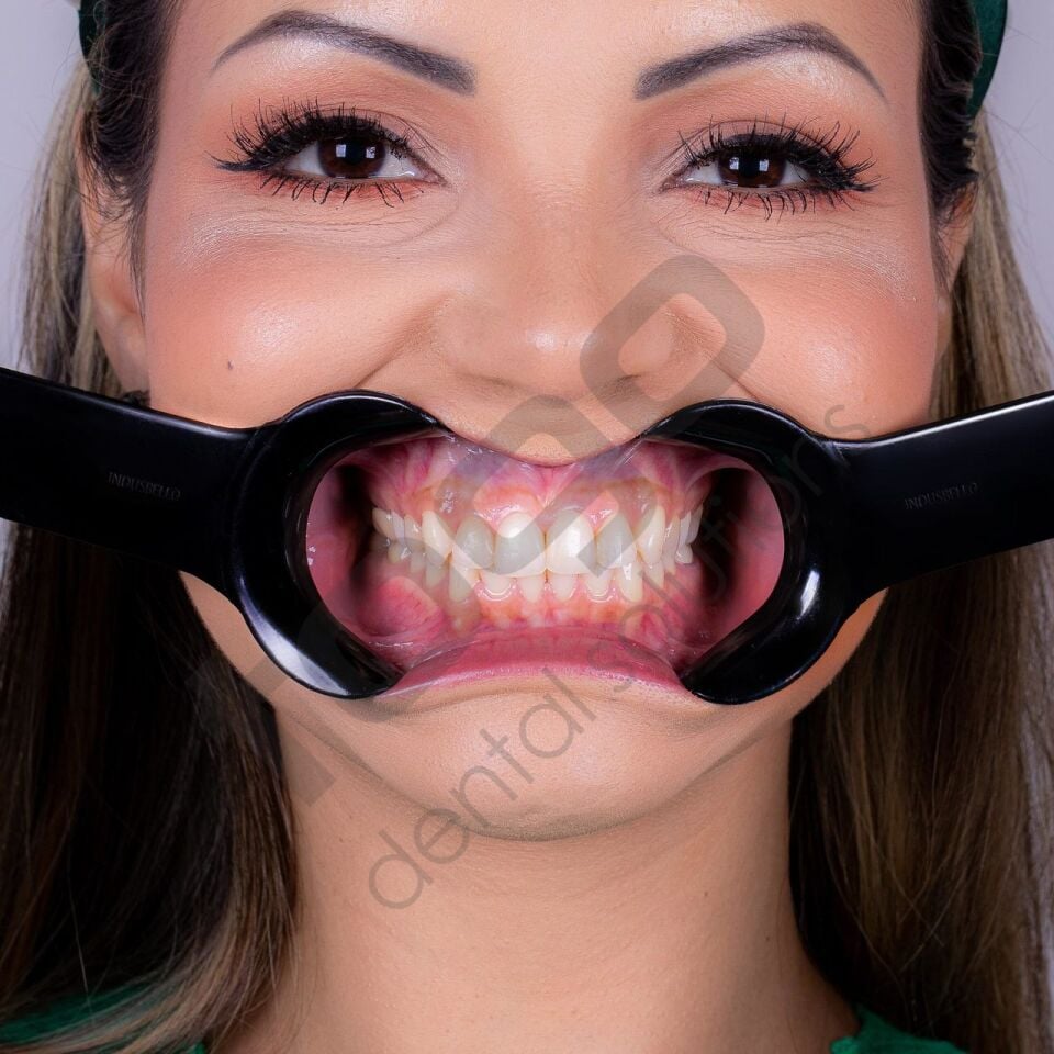 Indusbello Dental Fotoğrafçılık Ekartör Model:C