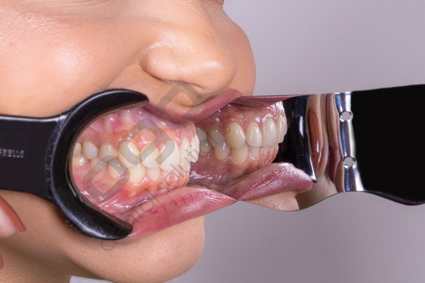 Indusbello Dental Fotoğrafçılık Ekartör Model:C