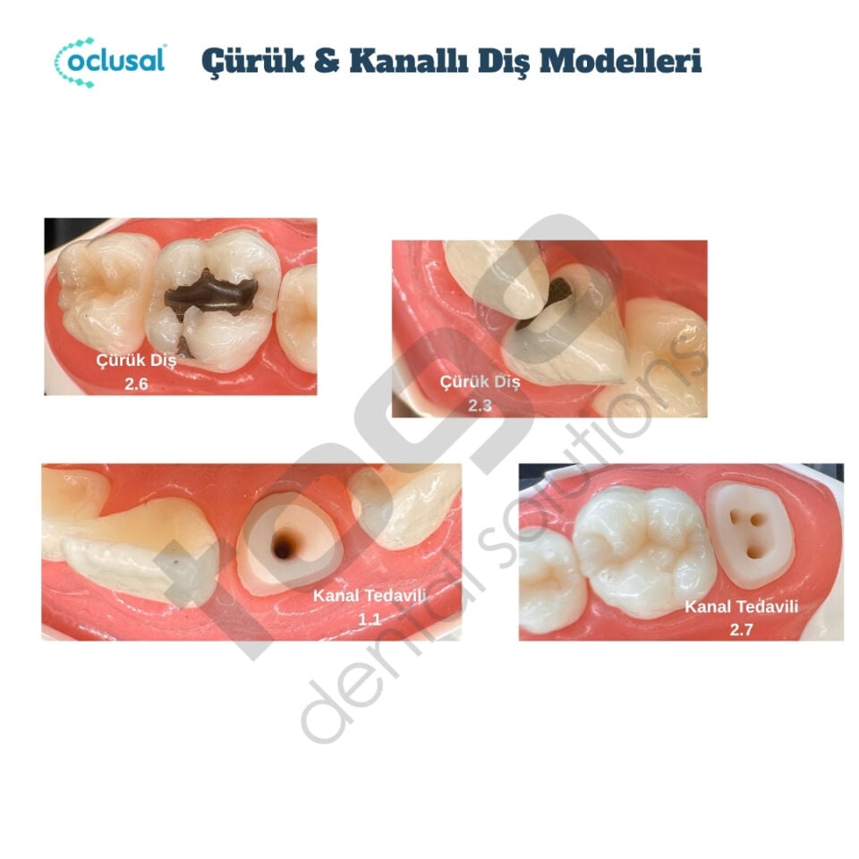 P-Oclusal Çürük & Kanallı Diş Eğitim Modelleri