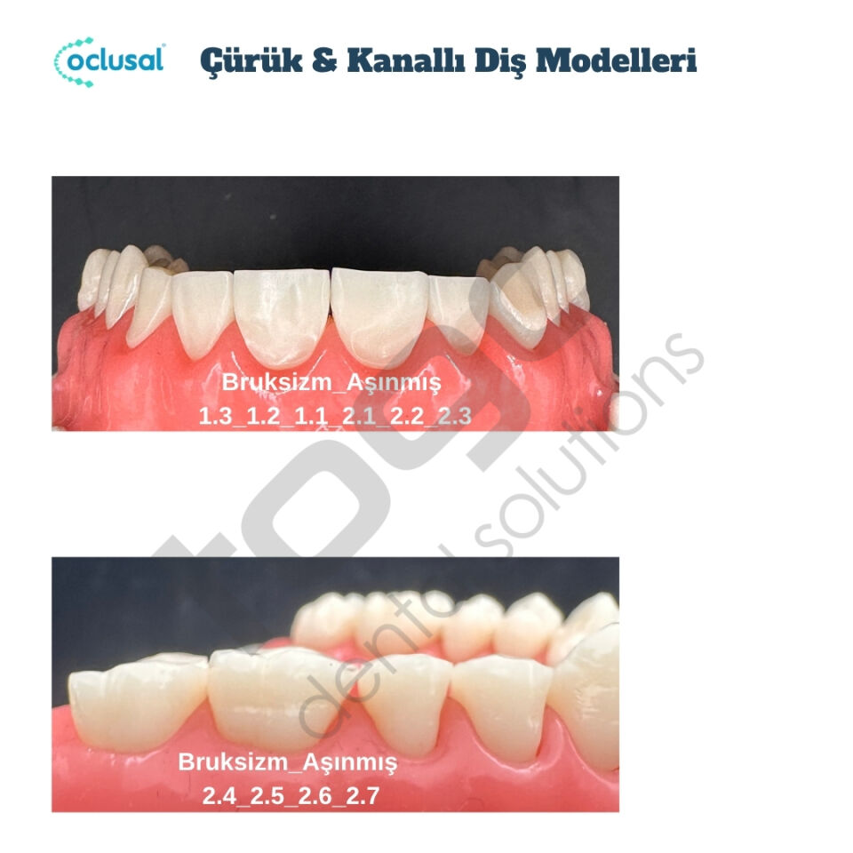P-Oclusal Bruksizm, Aşınmış Diş Eğitim Modelleri