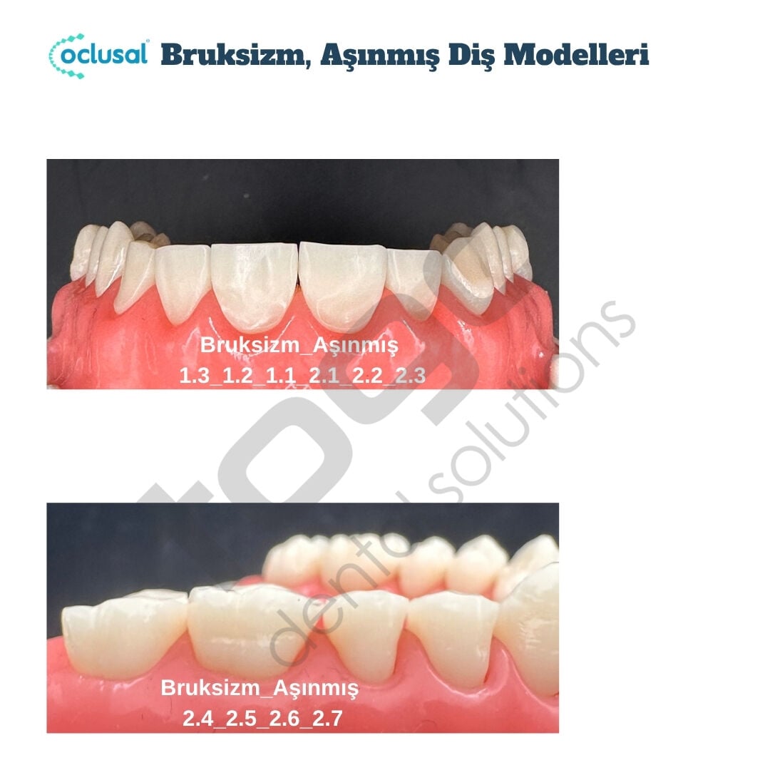 P-Oclusal Bruksizm, Aşınmış Diş Eğitim Modelleri
